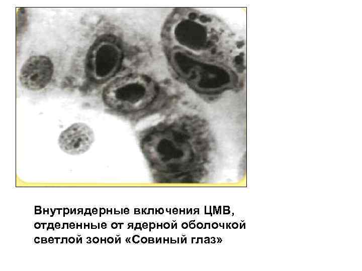 Внутриядерные включения ЦМВ, отделенные от ядерной оболочкой светлой зоной «Совиный глаз» 