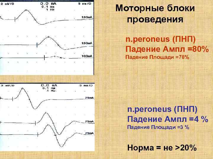 Блоки проведения. F-волна ЭНМГ норма. Блок проведения ЭНМГ. F волны при ЭНМГ. ЭНМГ М-ответ.