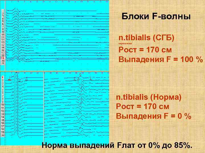 Блоки F-волны n. tibialis (СГБ) черепанова Рост = 170 см Выпадения F = 100