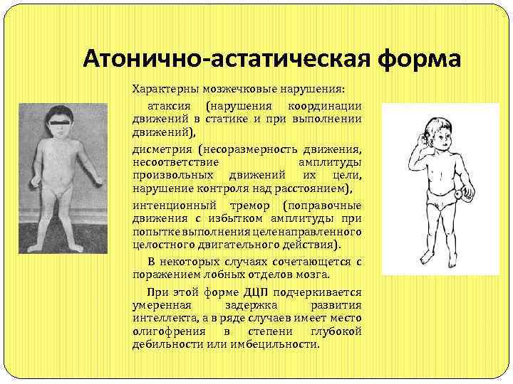  Атонично-астатическая форма Характерны мозжечковые нарушения: атаксия (нарушения координации движений в статике и при