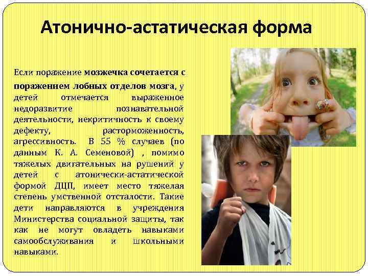 Атонично-астатическая форма Если поражение мозжечка сочетается с поражением лобных отделов мозга, у детей отмечается