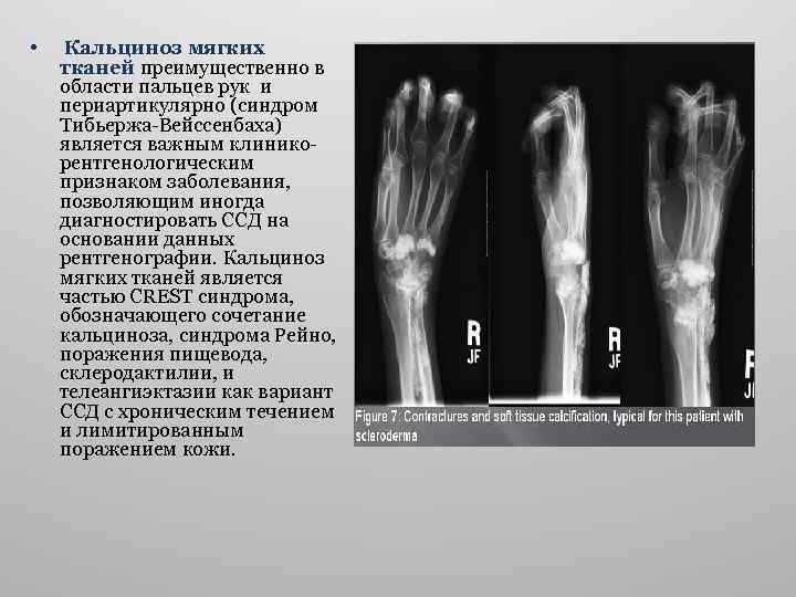  • Кальциноз мягких тканей преимущественно в области пальцев рук и периартикулярно (синдром Тибьержа-Вейссенбаха)