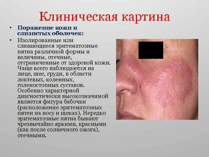 Клиническая картина • Поражение кожи и слизистых оболочек: • Изолированные или сливающиеся эритематозные пятна