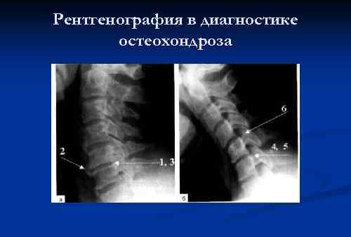 Рентгенография в диагностике остеохондроза 