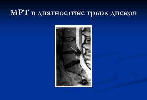 МРТ в диагностике грыж дисков 