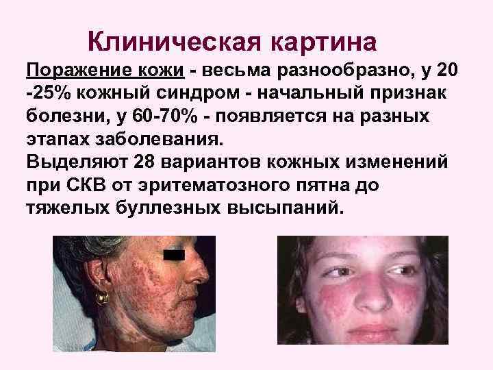 Клиническая картина Поражение кожи - весьма разнообразно, у 20 -25% кожный синдром - начальный
