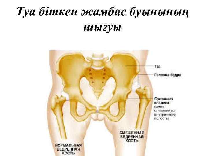 Туа біткен жамбас буынының шығуы 