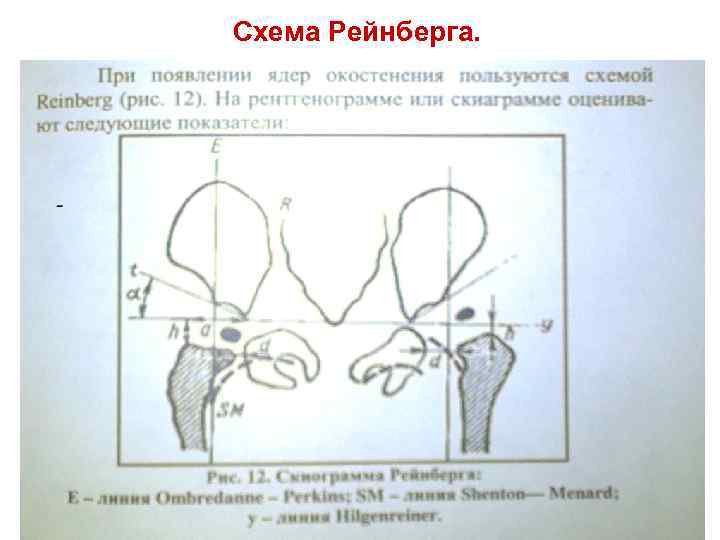 Ацетабулярный угол у детей