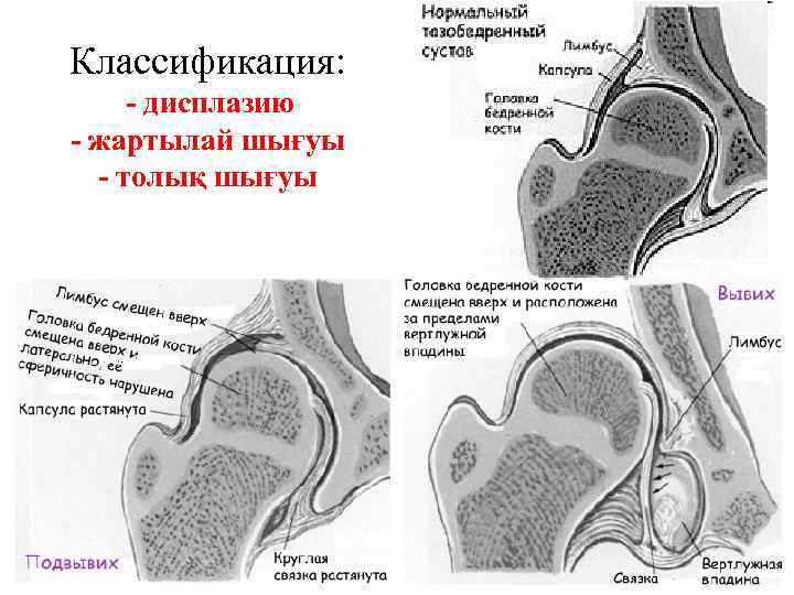 Классификация: - дисплазию - жартылай шығуы - толық шығуы 