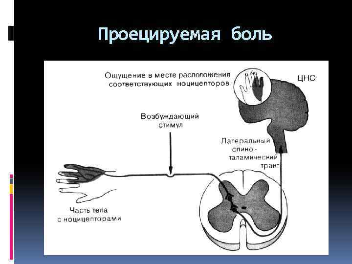 Проецируемая боль 