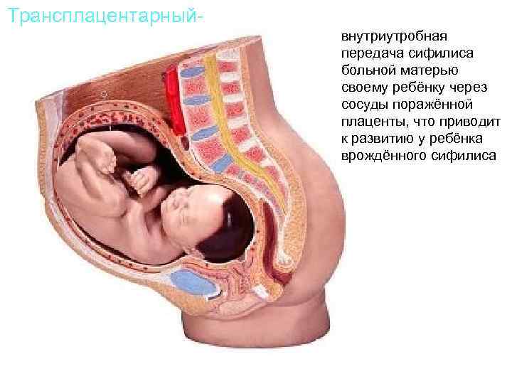 Трансплацентарныйвнутриутробная передача сифилиса больной матерью своему ребёнку через сосуды поражённой плаценты, что приводит к