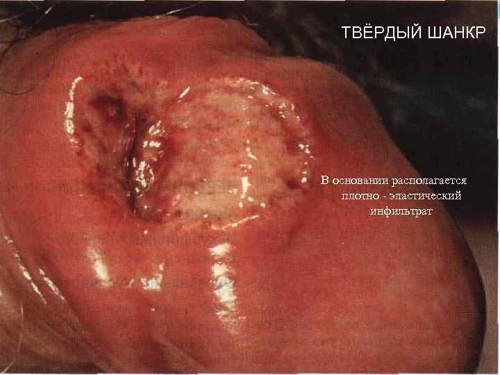 ТВЁРДЫЙ ШАНКР В основании располагается плотно - эластический инфильтрат 