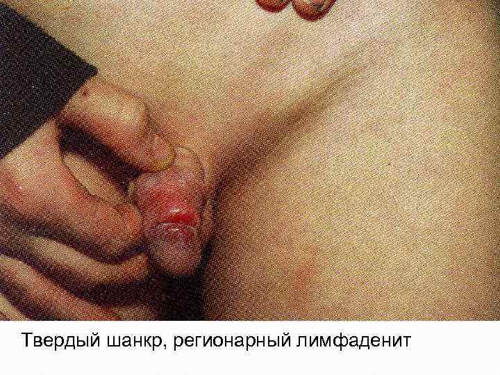 Твердый шанкр, регионарный лимфаденит 