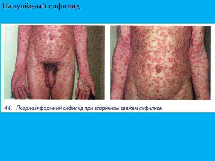 Папулёзный сифилид 