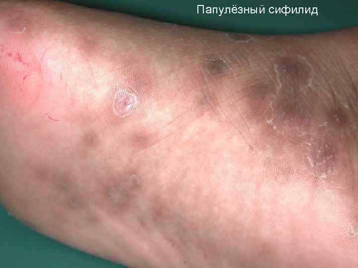 Папулёзный сифилид 