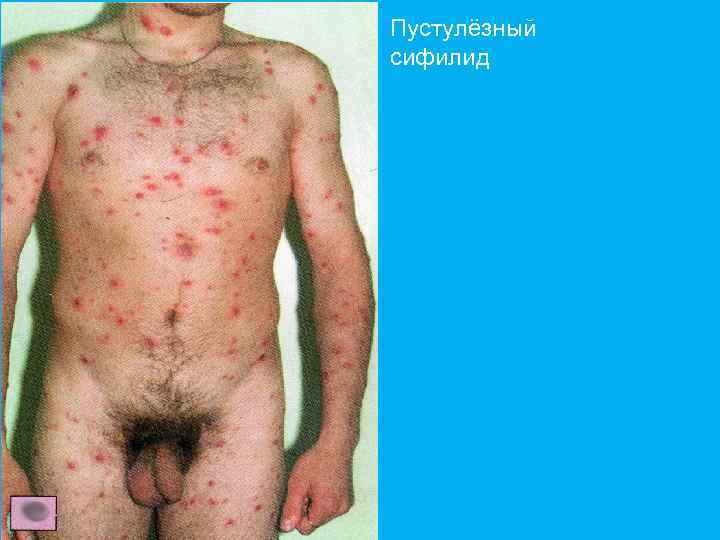 Пустулёзный сифилид 