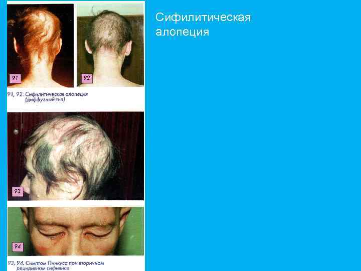 Сифилитическая алопеция 