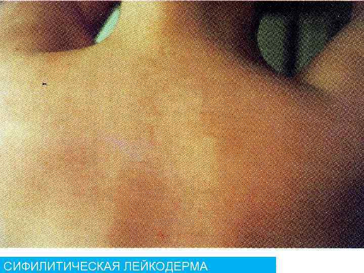 СИФИЛИТИЧЕСКАЯ ЛЕЙКОДЕРМА 