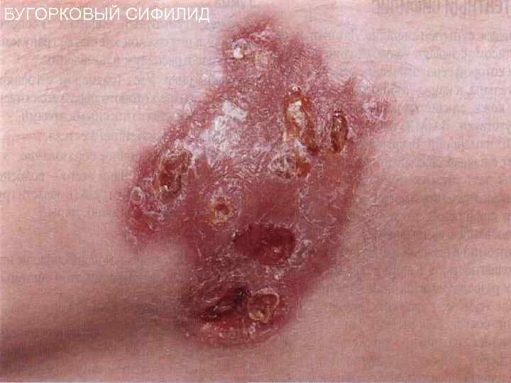 БУГОРКОВЫЙ СИФИЛИД 