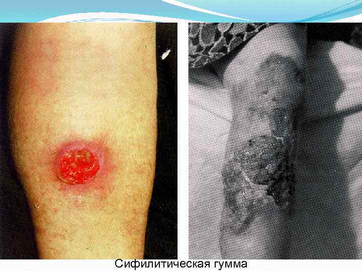 Сифилитическая гумма 