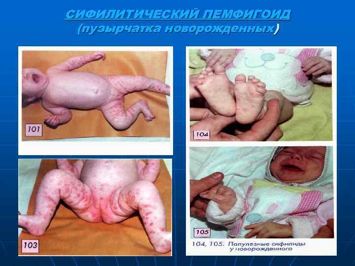 СИФИЛИТИЧЕСКИЙ ПЕМФИГОИД (пузырчатка новорожденных) 