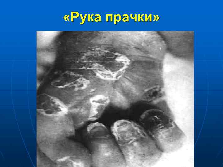  «Рука прачки» 