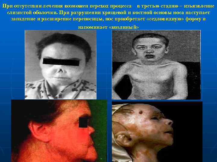 При отсутствии лечения возможен переход процесса в третью стадию – изъязвление слизистой оболочки. При