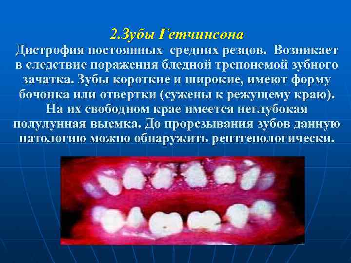 2. Зубы Гетчинсона Дистрофия постоянных средних резцов. Возникает в следствие поражения бледной трепонемой зубного