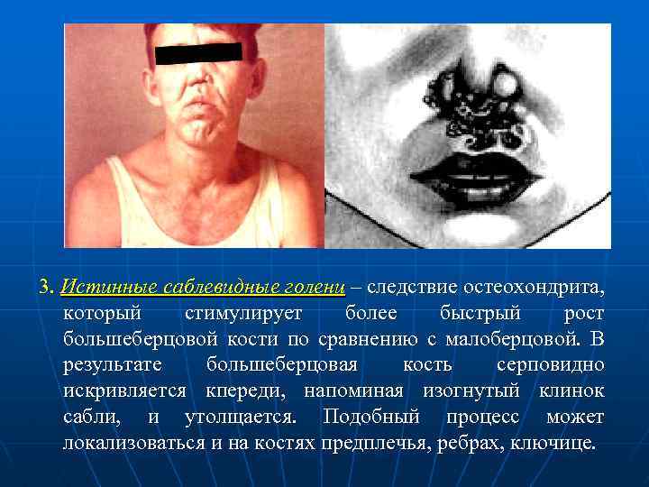 3. Истинные саблевидные голени – следствие остеохондрита, который стимулирует более быстрый рост большеберцовой кости