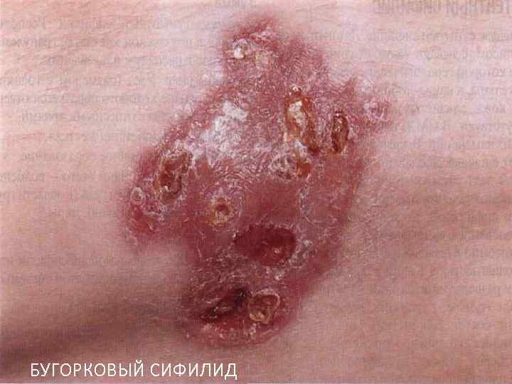 БУГОРКОВЫЙ СИФИЛИД 