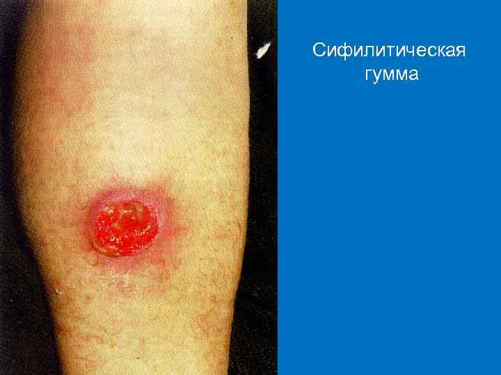 Сифилитическая гумма 