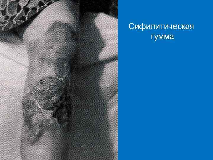 Сифилитическая гумма 