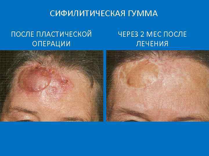 СИФИЛИТИЧЕСКАЯ ГУММА ПОСЛЕ ПЛАСТИЧЕСКОЙ ОПЕРАЦИИ ЧЕРЕЗ 2 МЕС ПОСЛЕ ЛЕЧЕНИЯ 