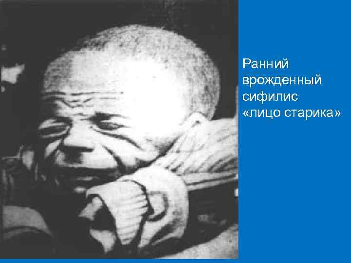 Ранний врожденный сифилис «лицо старика» 