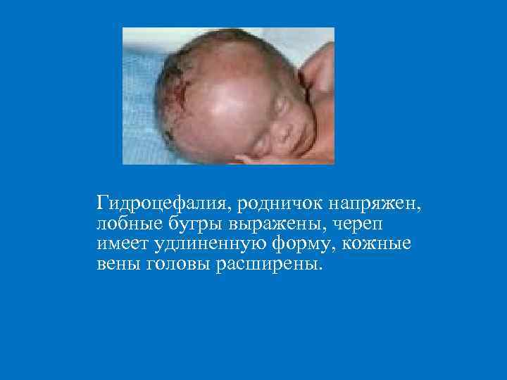 Гидроцефалия, родничок напряжен, лобные бугры выражены, череп имеет удлиненную форму, кожные вены головы расширены.