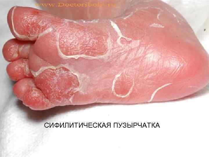 СИФИЛИТИЧЕСКАЯ ПУЗЫРЧАТКА 