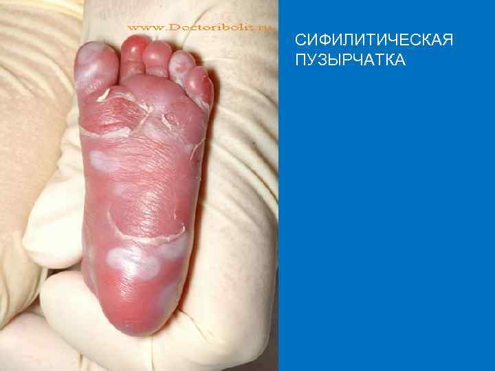 СИФИЛИТИЧЕСКАЯ ПУЗЫРЧАТКА 