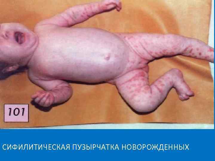 СИФИЛИТИЧЕСКАЯ ПУЗЫРЧАТКА НОВОРОЖДЕННЫХ 