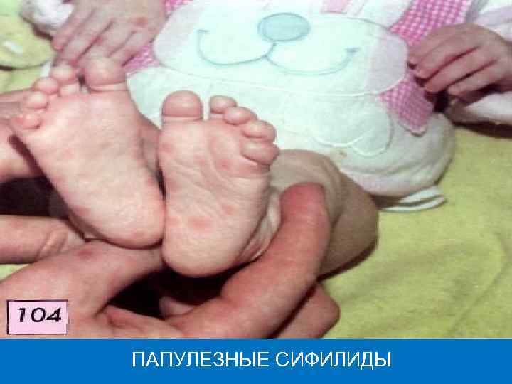 ПАПУЛЕЗНЫЕ СИФИЛИДЫ 