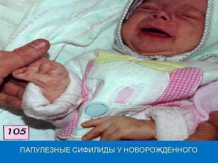 ПАПУЛЕЗНЫЕ СИФИЛИДЫ У НОВОРОЖДЕННОГО 