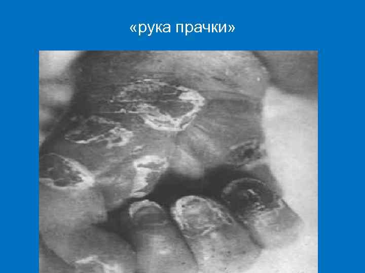  «рука прачки» 