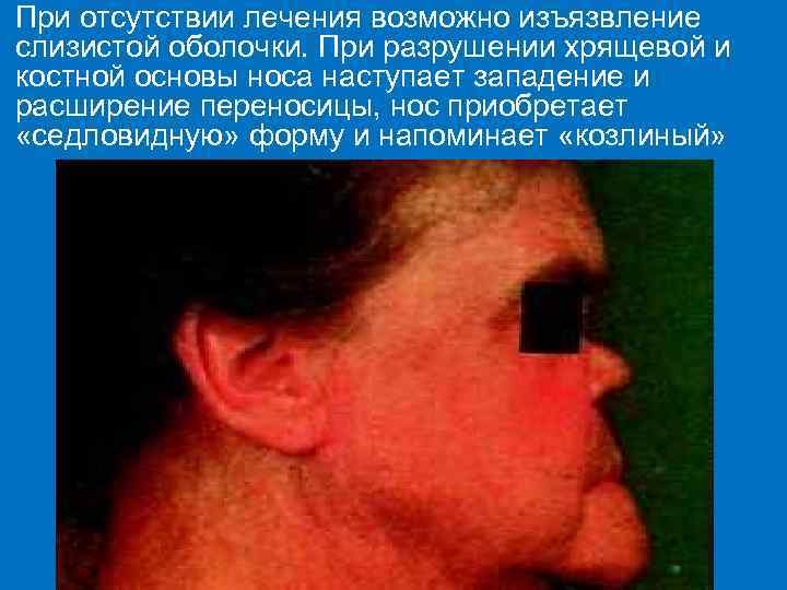 При отсутствии лечения возможно изъязвление слизистой оболочки. При разрушении хрящевой и костной основы носа