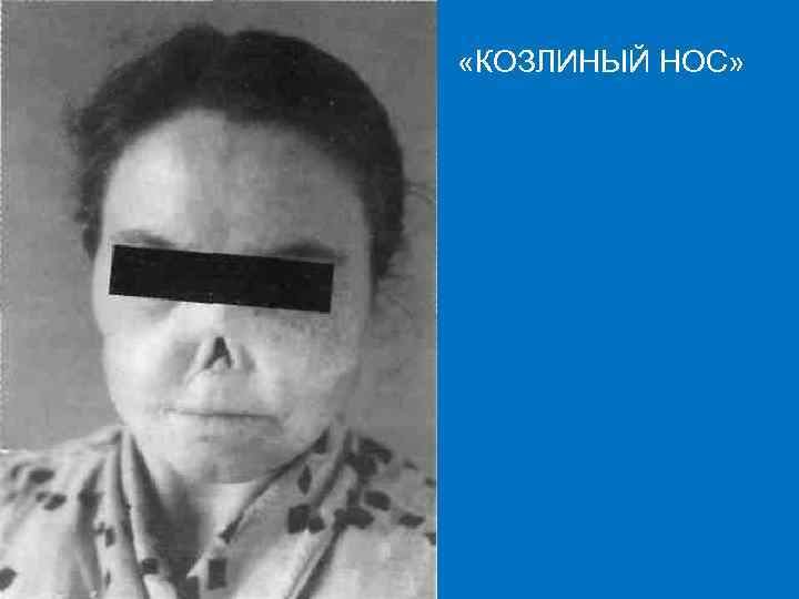  «КОЗЛИНЫЙ НОС» 