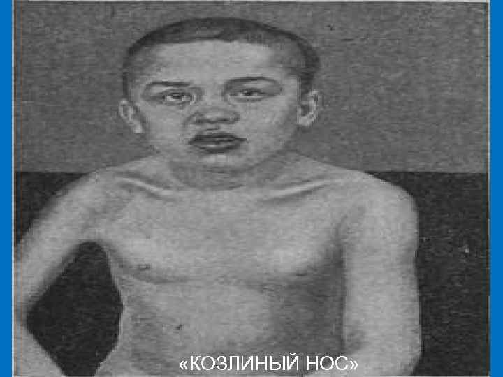  «КОЗЛИНЫЙ НОС» 