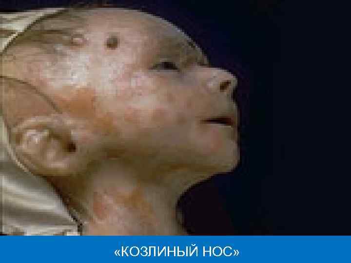  «КОЗЛИНЫЙ НОС» 