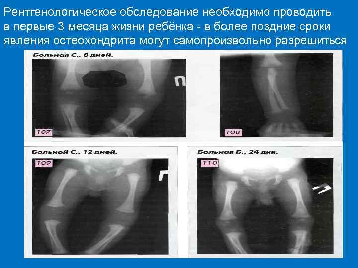 Рентгенологическое обследование необходимо проводить в первые 3 месяца жизни ребёнка - в более поздние
