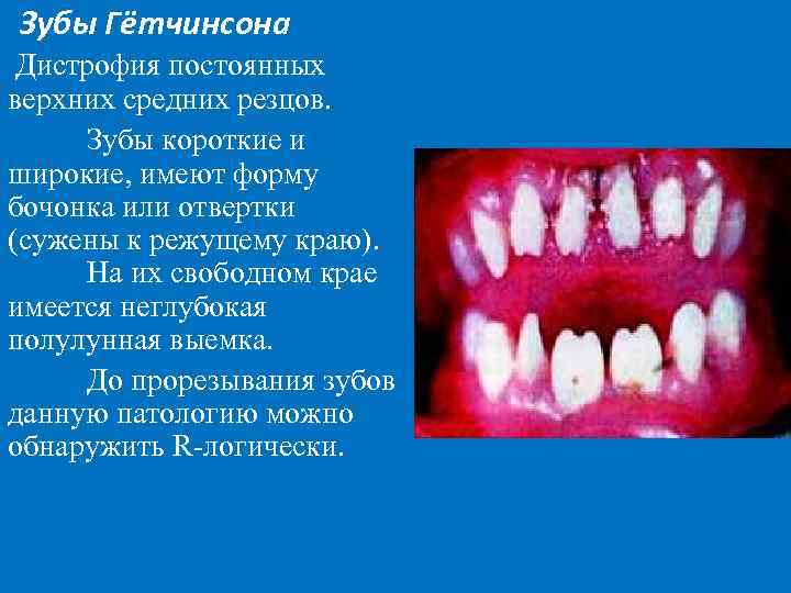 Зубы Гётчинсона Дистрофия постоянных верхних средних резцов. Зубы короткие и широкие, имеют форму бочонка