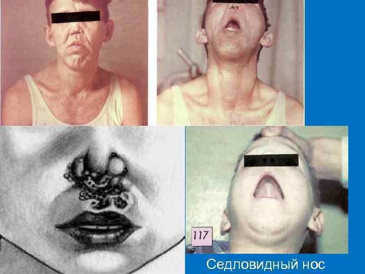 Седловидный нос 