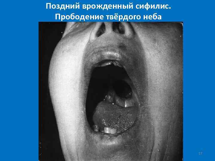 Поздний врожденный сифилис. Прободение твёрдого неба 57 