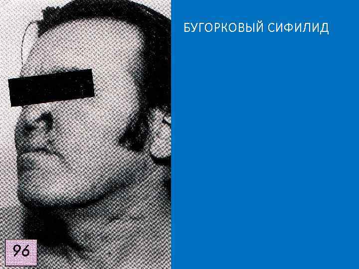БУГОРКОВЫЙ СИФИЛИД 